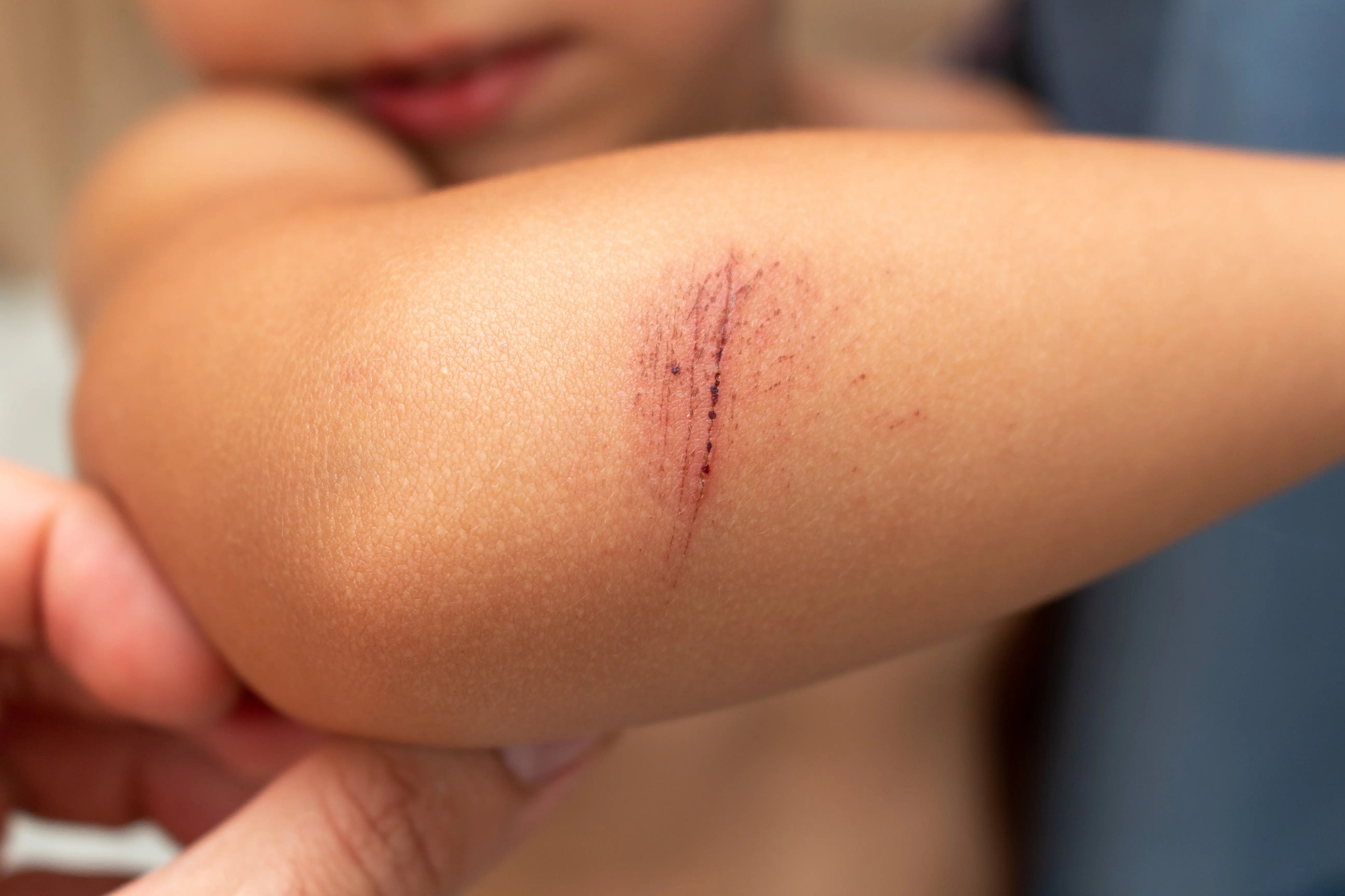 What is skin chafing and how to prevent it