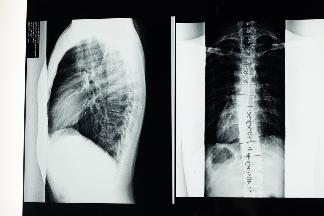 x-ray image of spine and back